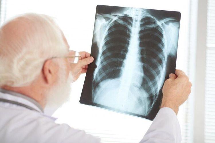 Who : Tuberkulosis Jadi Penyakit Paling Menular dan Mematikan Di Dunia