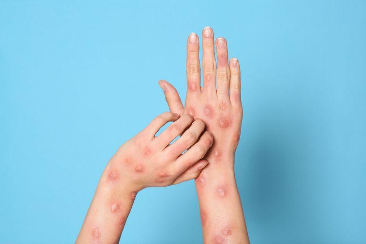 Monkeypox: Penyebab, Penyebaran, dan Cara Mengatasinya